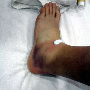 El tobillo de Iñigo López, como él mismo muestra en su cuenta de twitter